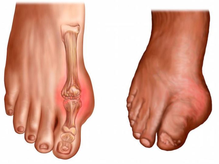 Gotta: la dieta che potenzia l’effetto dei farmaci