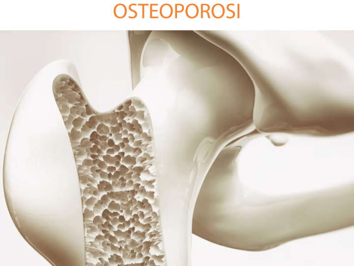 OSTEOPOROSI