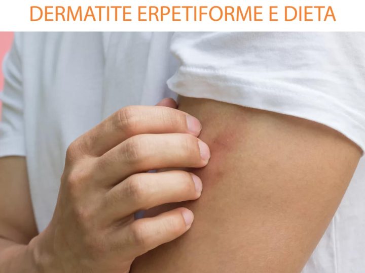 DERMATITE ERPETIFORME E DIETA